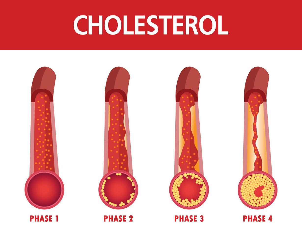 colesterol en artería, salud riesgo , vector ilustración.