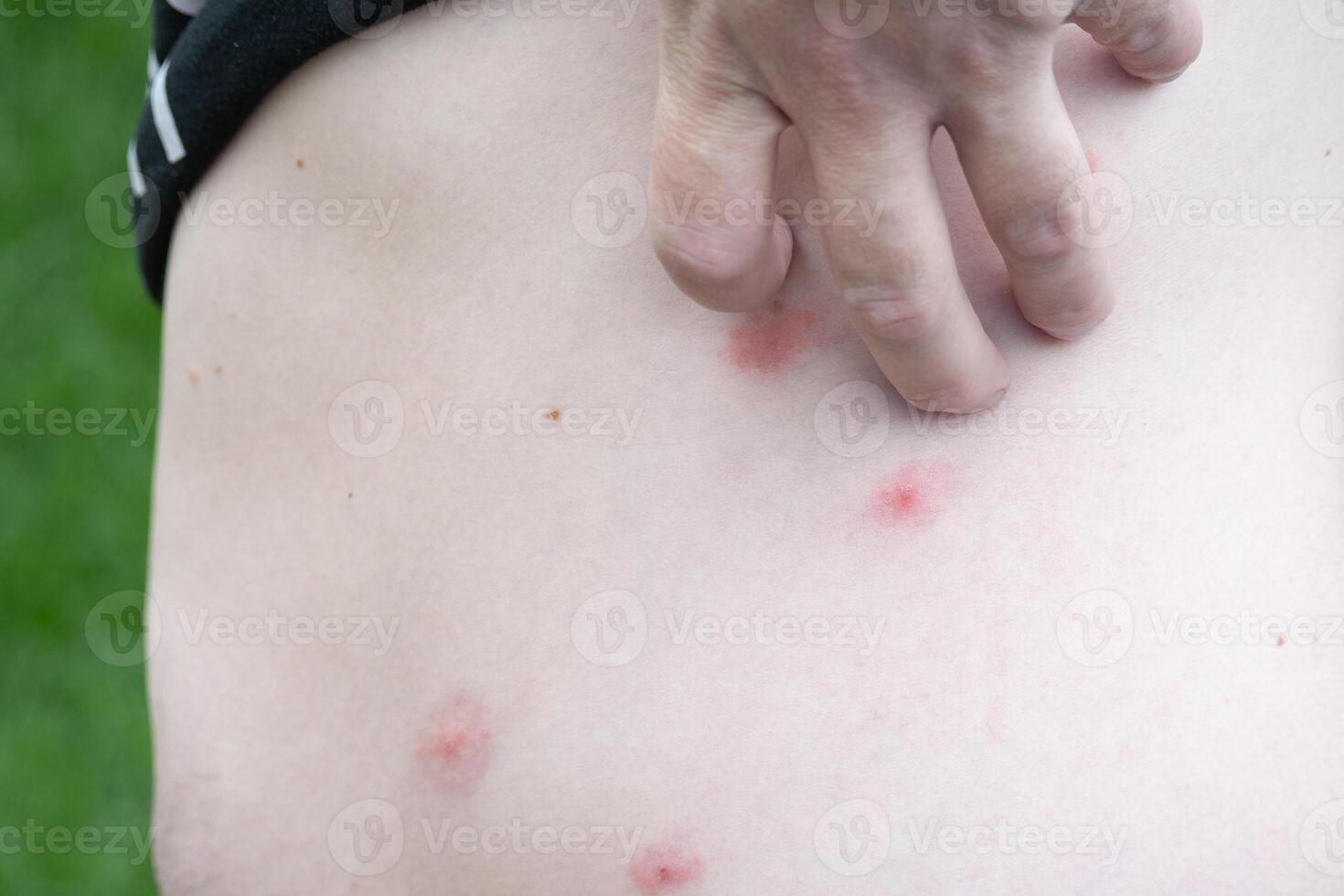 Bites on the skin of a man. photo