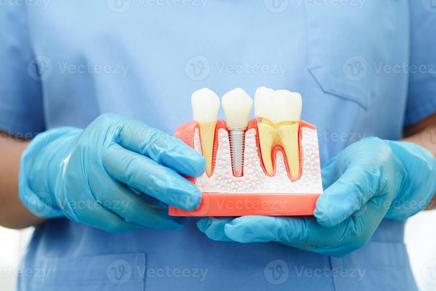 Doctor hold dental implant, artificial tooth roots into jaw, root canal of dental treatment, gum disease, teeth model for dentist studying about dentistry. photo