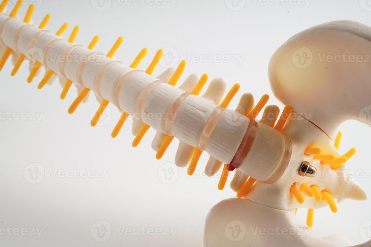 Spinal nerve and bone, Lumbar spine displaced herniated disc fragment, Model for treatment medical in the orthopedic department. photo