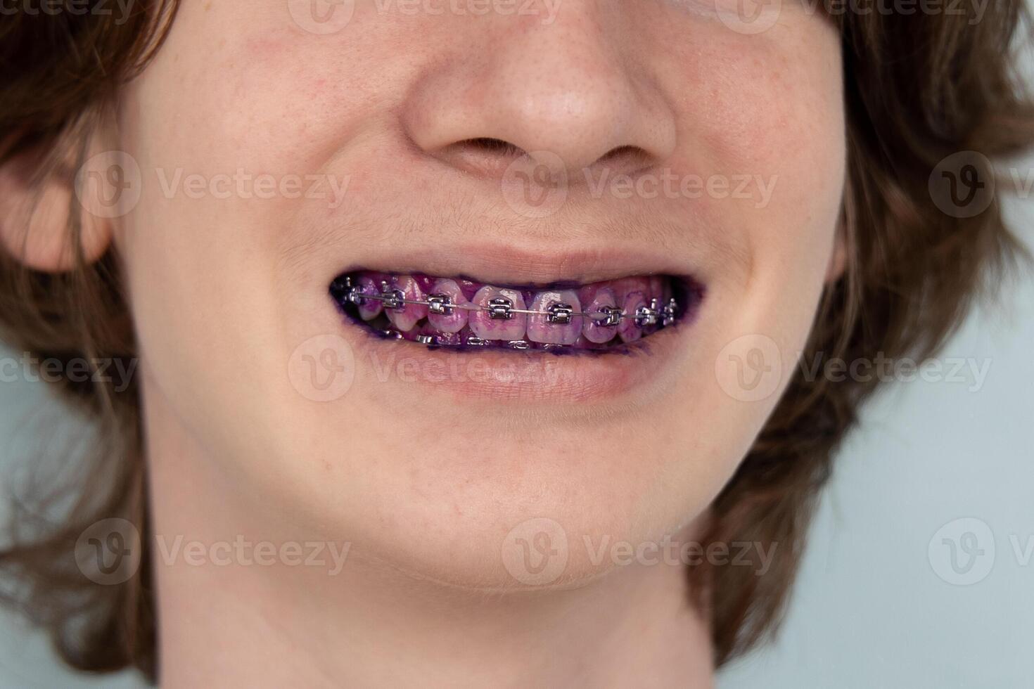 Plaque indicator on human teeth with braces. Plaque is colored pink. Teenager using plaque indicator gel photo