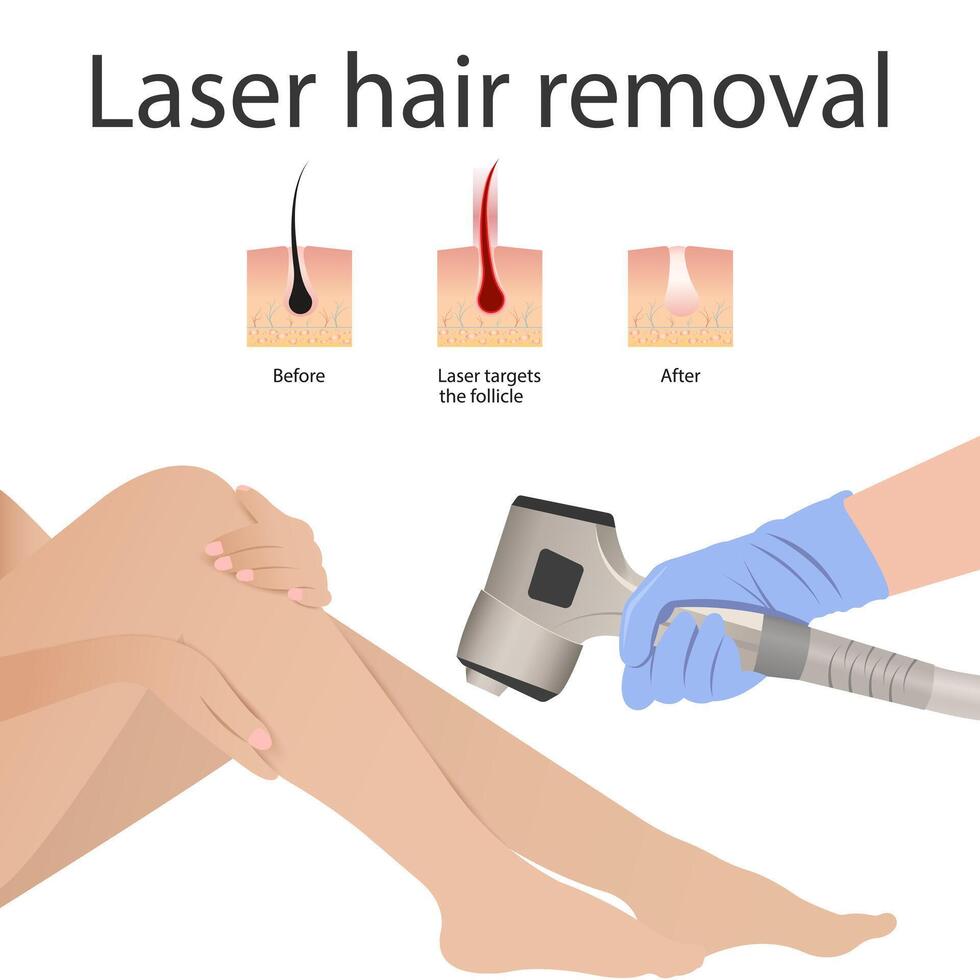 Laser hair removal of women's legs. Modern equipment for laser hair removal cosmetic procedures in a beauty salon vector