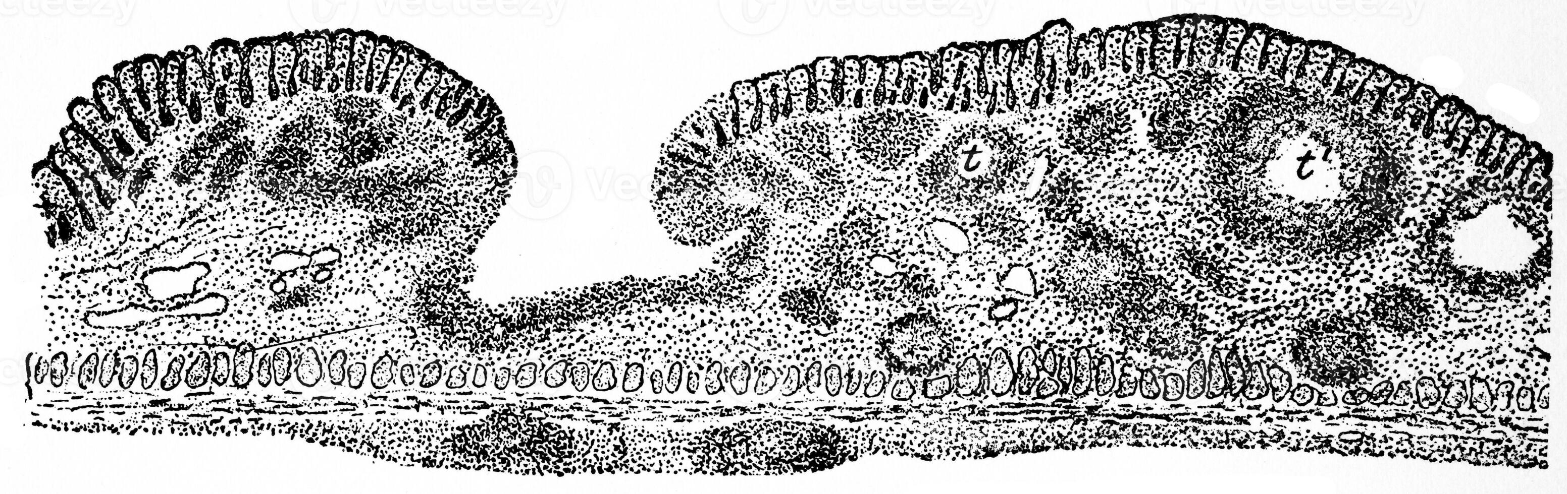 Tubercular ulcer, vintage engraving. photo