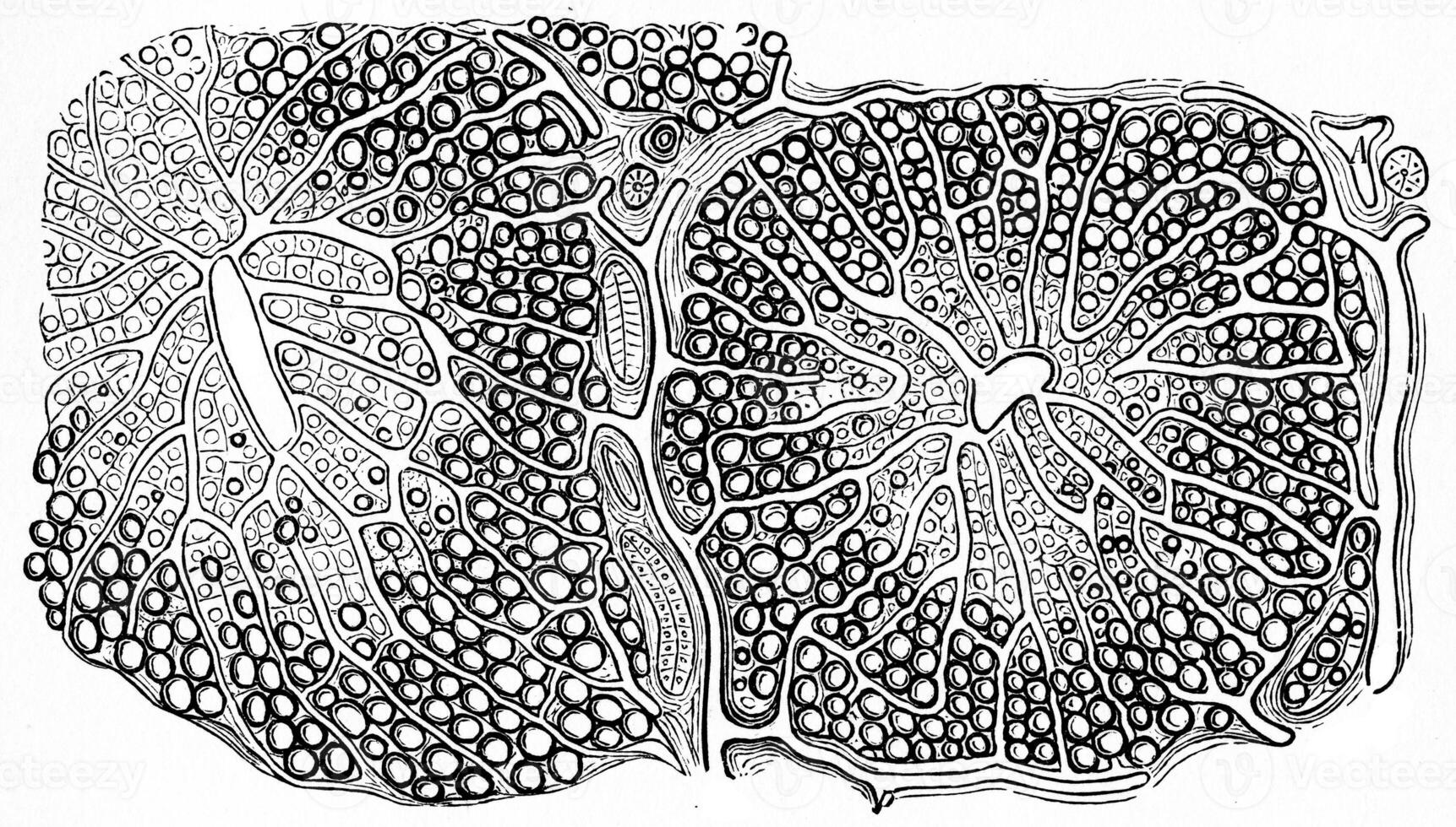 Fatty infiltration of the liver, vintage engraving. photo