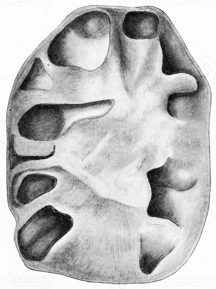 Tuberculous pyelonephritis, chronic ascending tuberculosis of the kidney, vintage engraving. photo