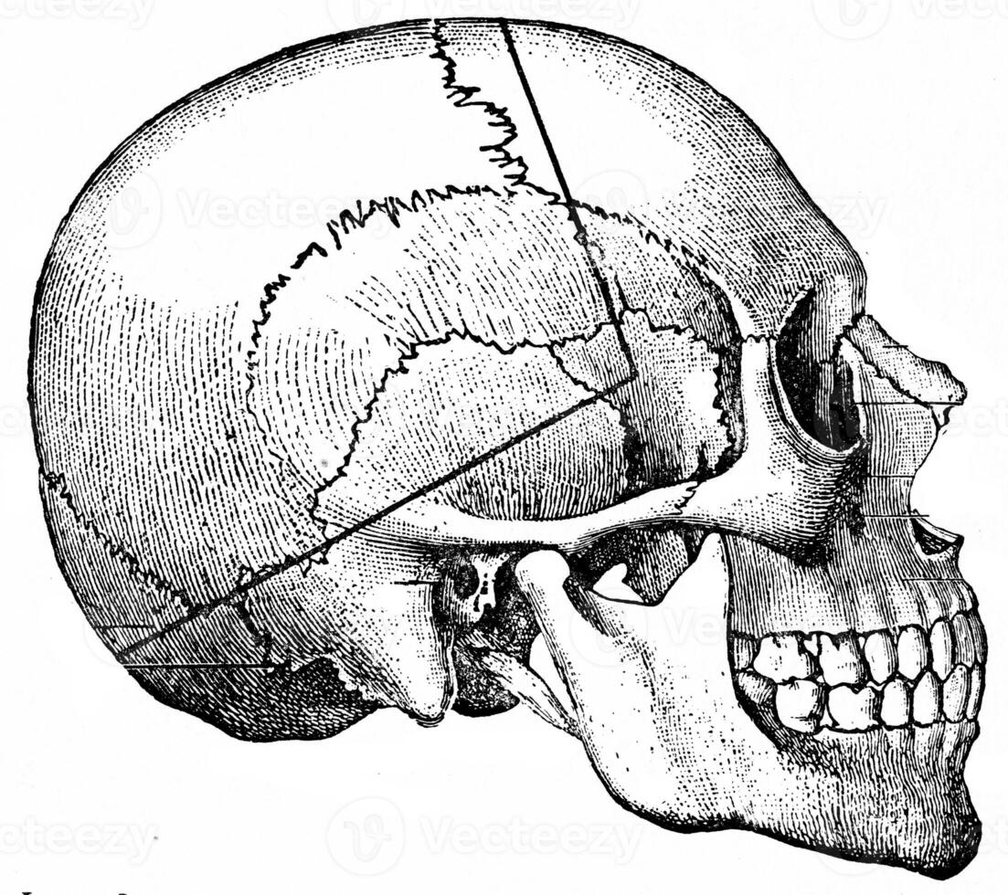 Heavy line indicating course taken by saw-cut in so called undertaker's method, vintage engraving. photo