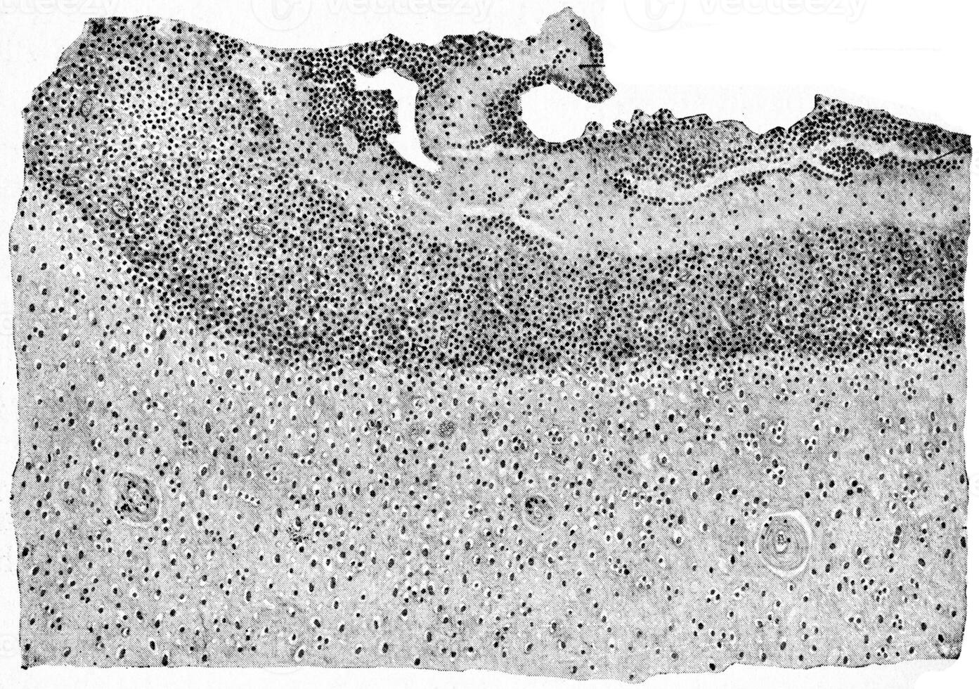 sección de humano cerebro incluso pared de cerebral absceso, Clásico grabado. foto