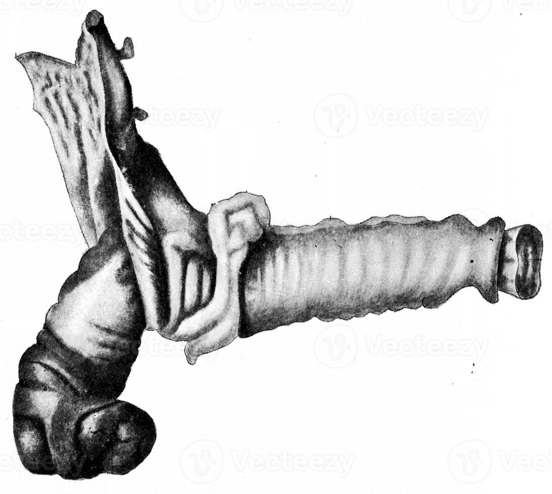 Intussusception at ileocecal valve, vintage engraving. photo