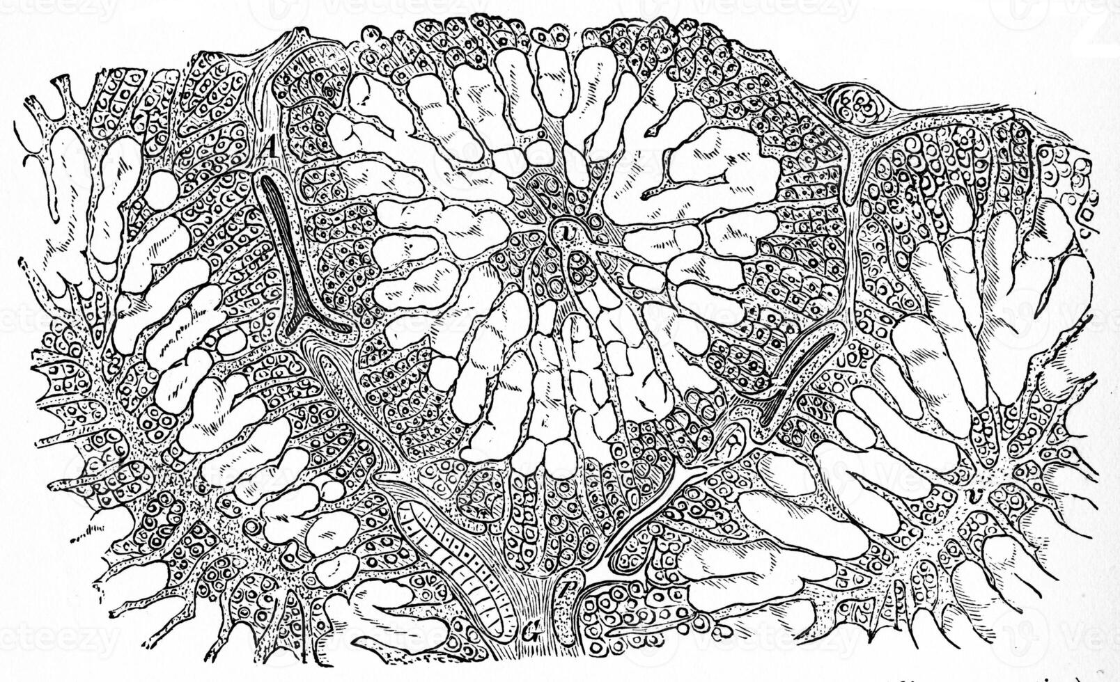 Liver, amyloid infiltration, vintage engraving. photo