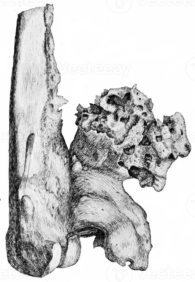 Osteophytes on the popliteal aspect of the lower end of the femur, vintage engraving. photo