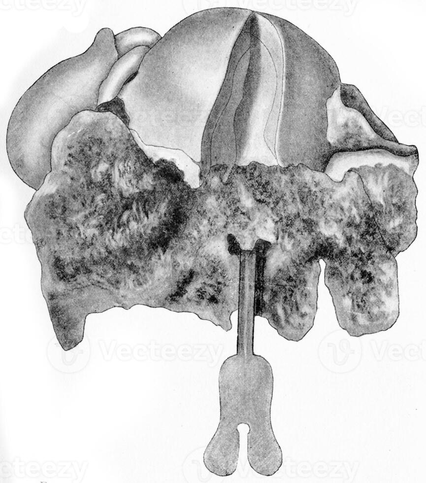 Cylindric-cell epithelioma of the cervix uteri, vintage engraving. photo