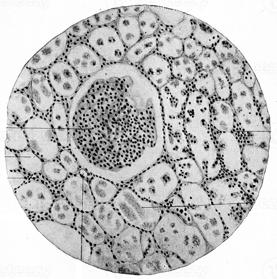 Chronic parenchymatous nephritis, vintage engraving. photo