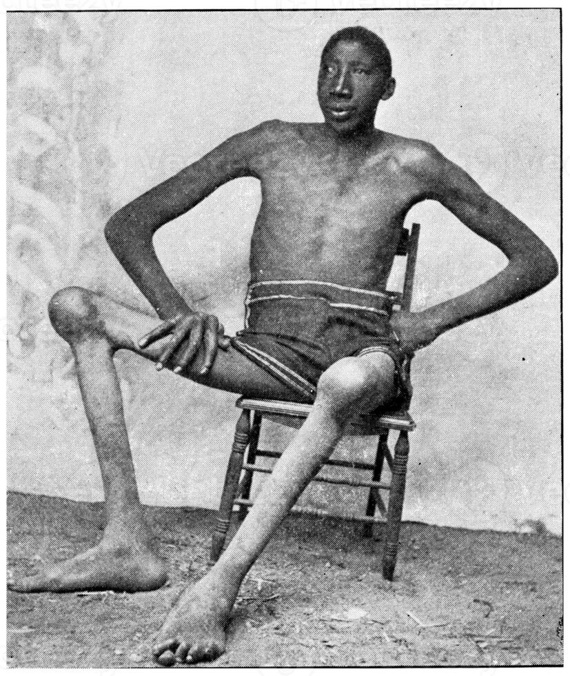 Acromegaly, vintage engraving. photo