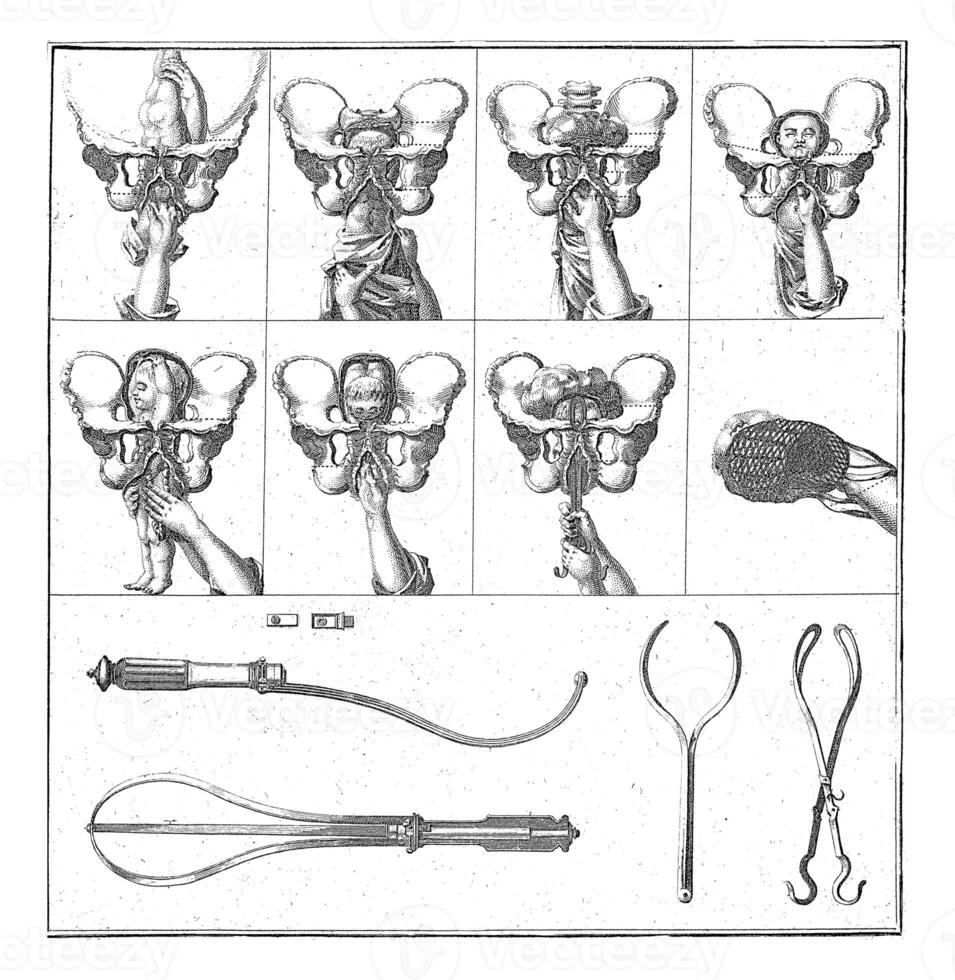 Gynaecological representations, Nicolaas van Frankendaal, after C. Plevier, 1730 - 1791 photo