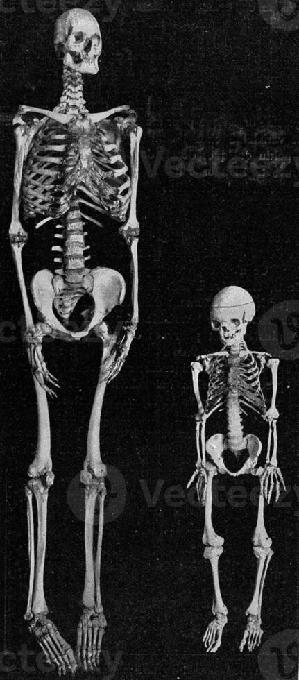 Skeleton of a giant and a dwarf, vintage engraving. photo