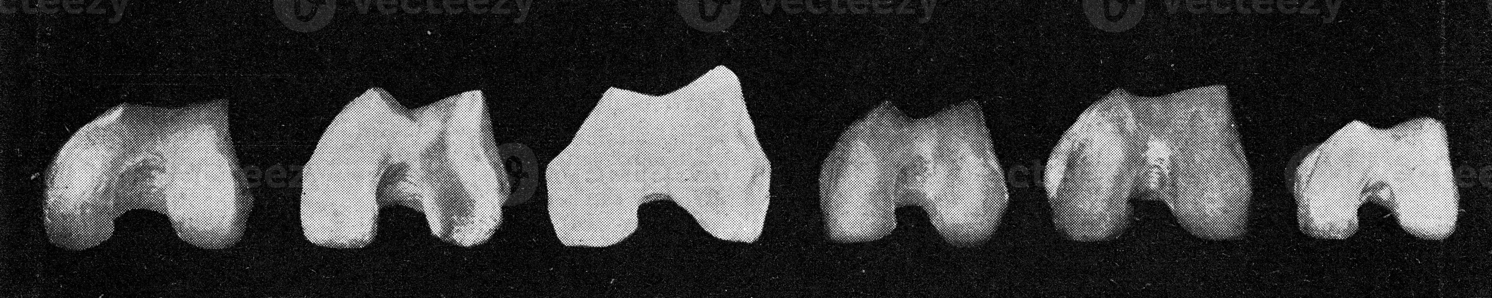 Comparative table of the surface of the knee joint of the femur of a European, an Australian, the Neanderthal man, an Australian, an African negro and photo