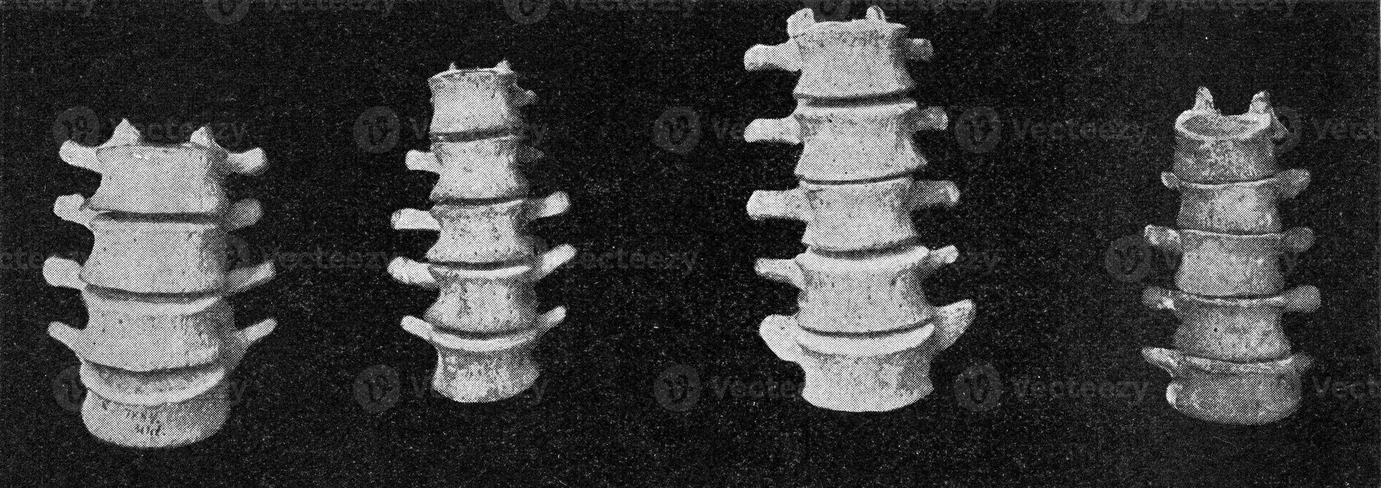 comparativo mesa de lumbar vertebral columnas de un europeo, un australiano, un africano negro y un enano negro de el filipinas, Clásico grabado. foto