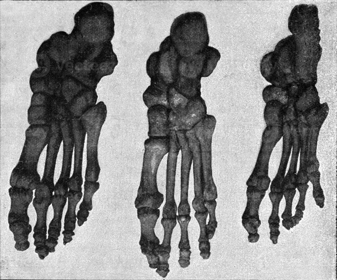 Comparative table of the skeleton of the foot of a Japanese, a European and an Australian, vintage engraving. photo