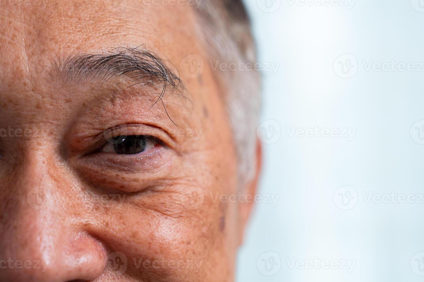 Close up of the senile cataract during eye examination. A white cloudy disc is seen in black eye circle, mature cataract, nuclear sclerosis cataract. Close up half face view photo