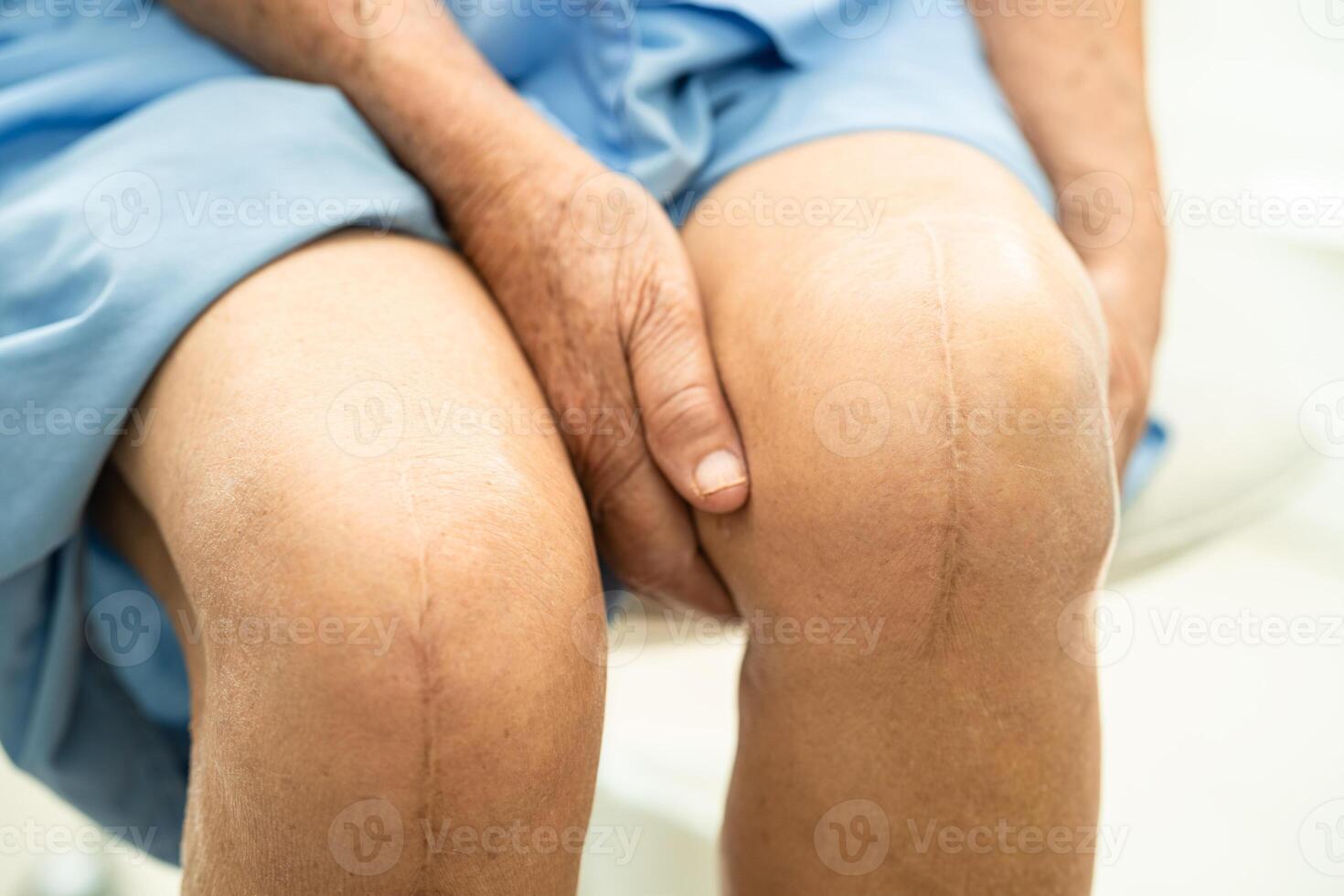 Asian elderly woman patient show her scars surgical total knee joint replacement Suture wound surgery arthroplasty in hospital. photo