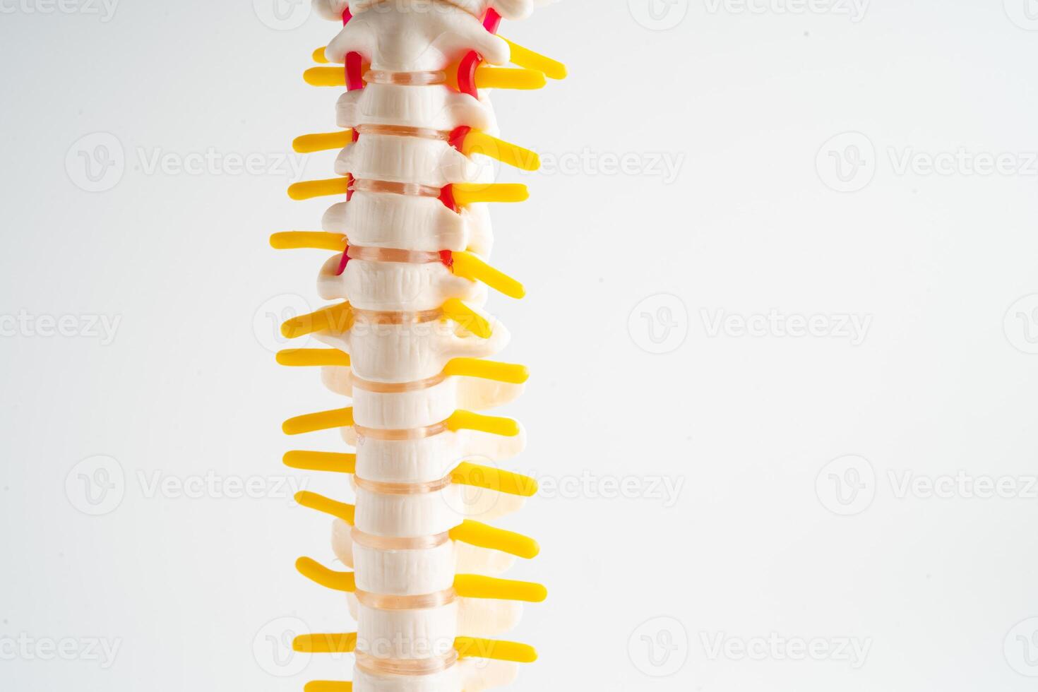 Lumbar spine displaced herniated disc fragment, spinal nerve and bone. Model for treatment medical in the orthopedic department. photo