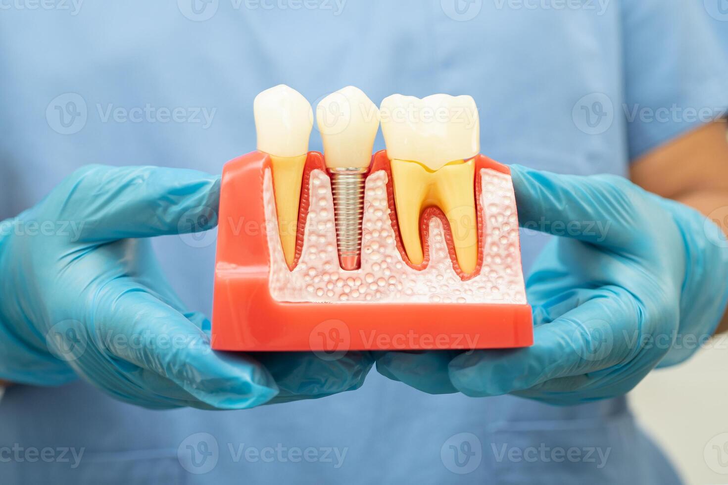 Dental implant, artificial tooth roots into jaw, root canal of dental treatment, gum disease, teeth model for dentist studying about dentistry. photo