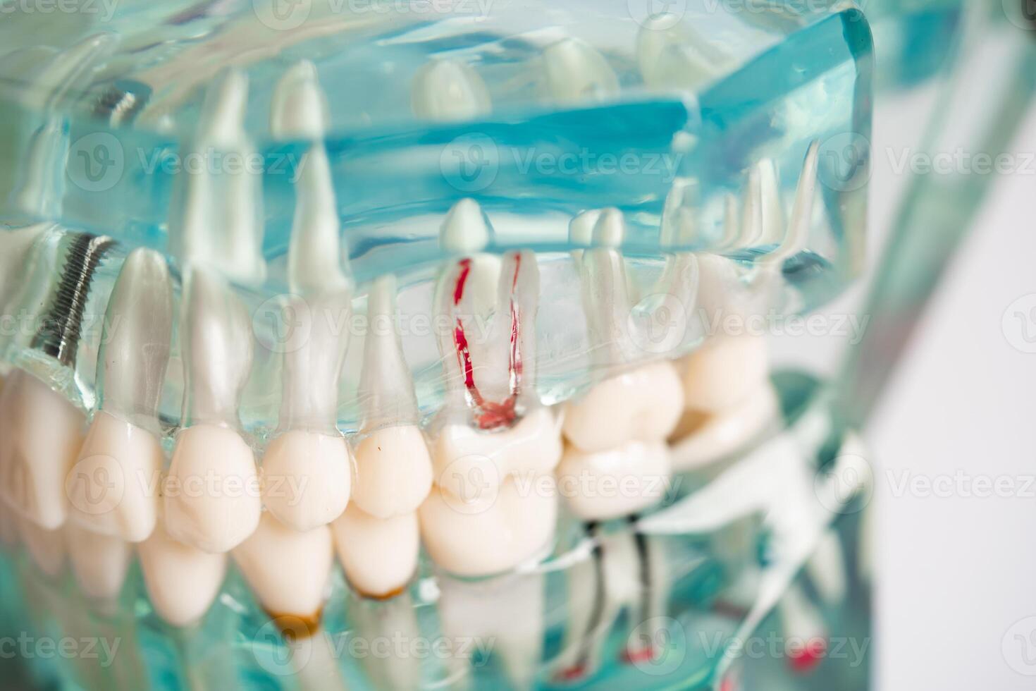 Dental implant, artificial tooth roots into jaw, root canal of dental treatment, gum disease, teeth model for dentist studying about dentistry. photo