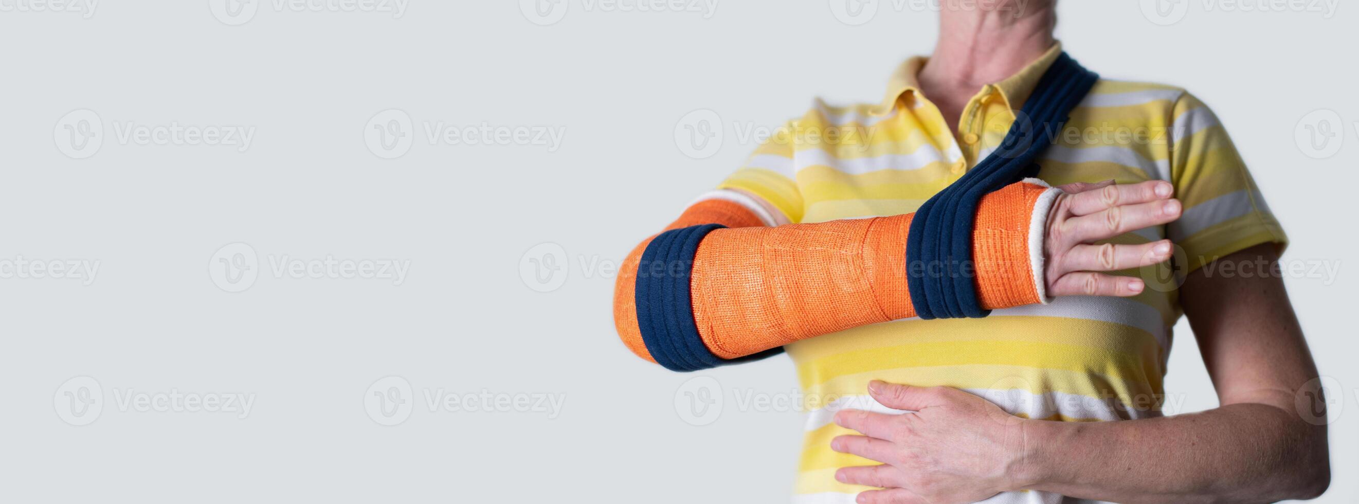 woman with a broken right arm in Fiberglass casts to hold broken bones in place until they heal, modern treatments, photo