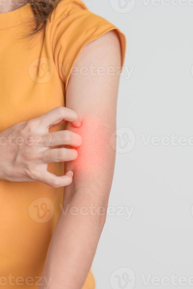 woman itching and scratching itchy arm. Sensitive Skin Allergic reaction to insect bite, food, drug dermatitis. Dermatology, Leprosy day, Systemic lupus erythematosus, Allergy symptoms and rash Eczema photo