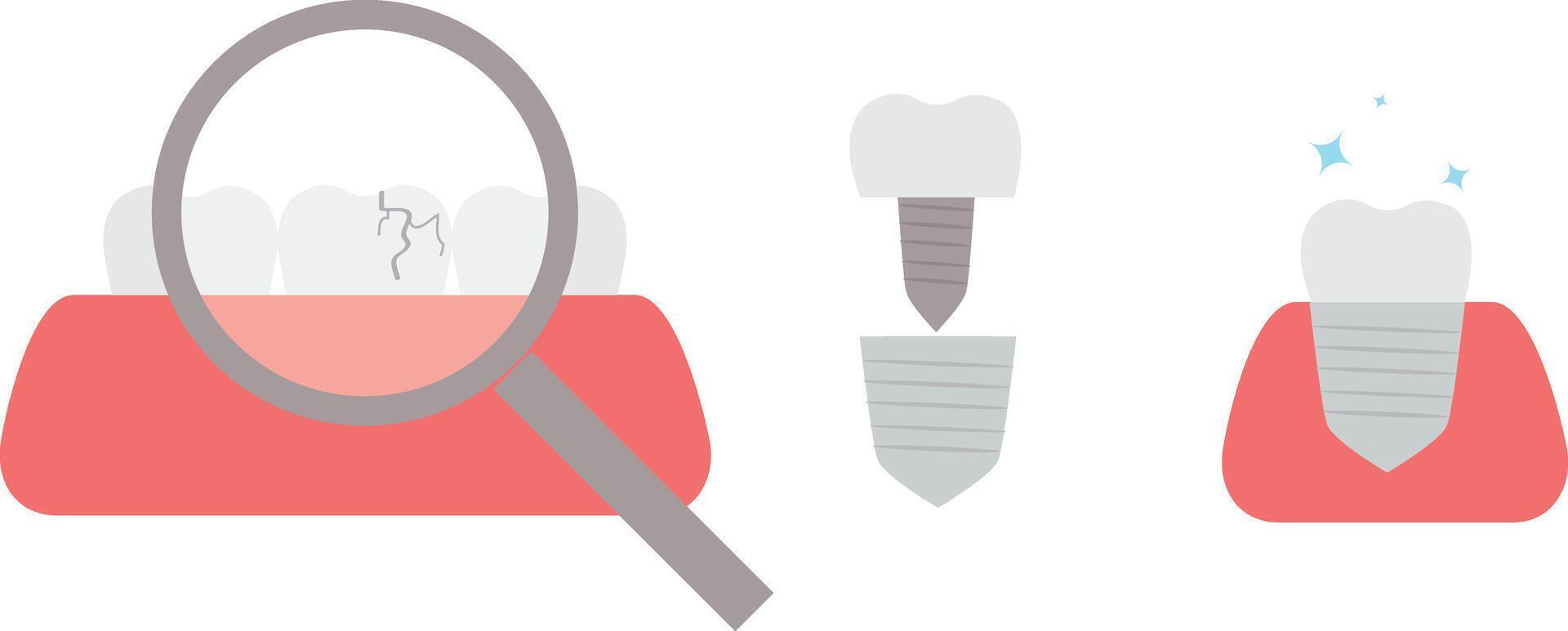 replacement of broken tooth with dental cap vector