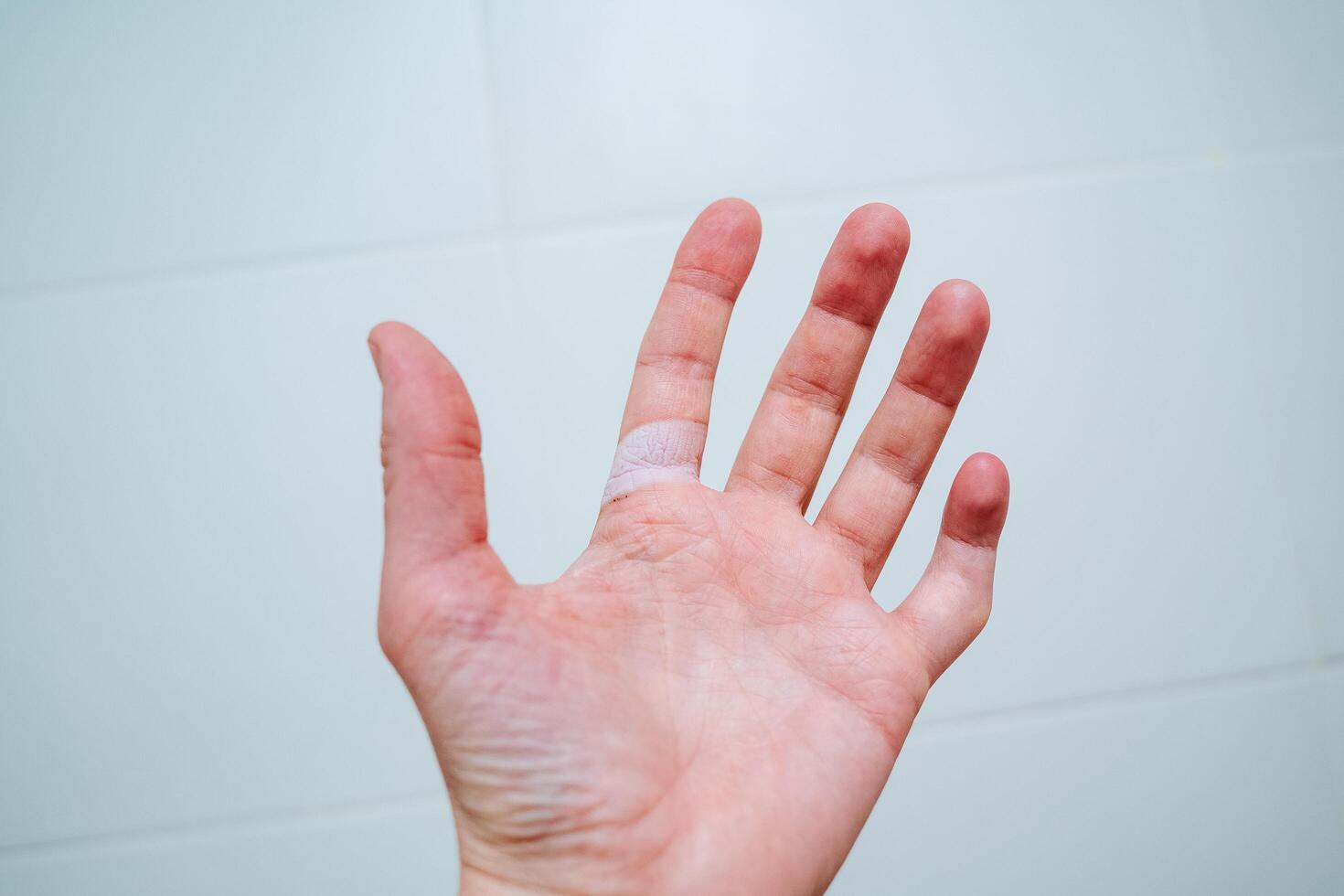 Wound on the index finger. Flabby skin on his arm. The site of skin lesions. Frostbite of the finger. photo