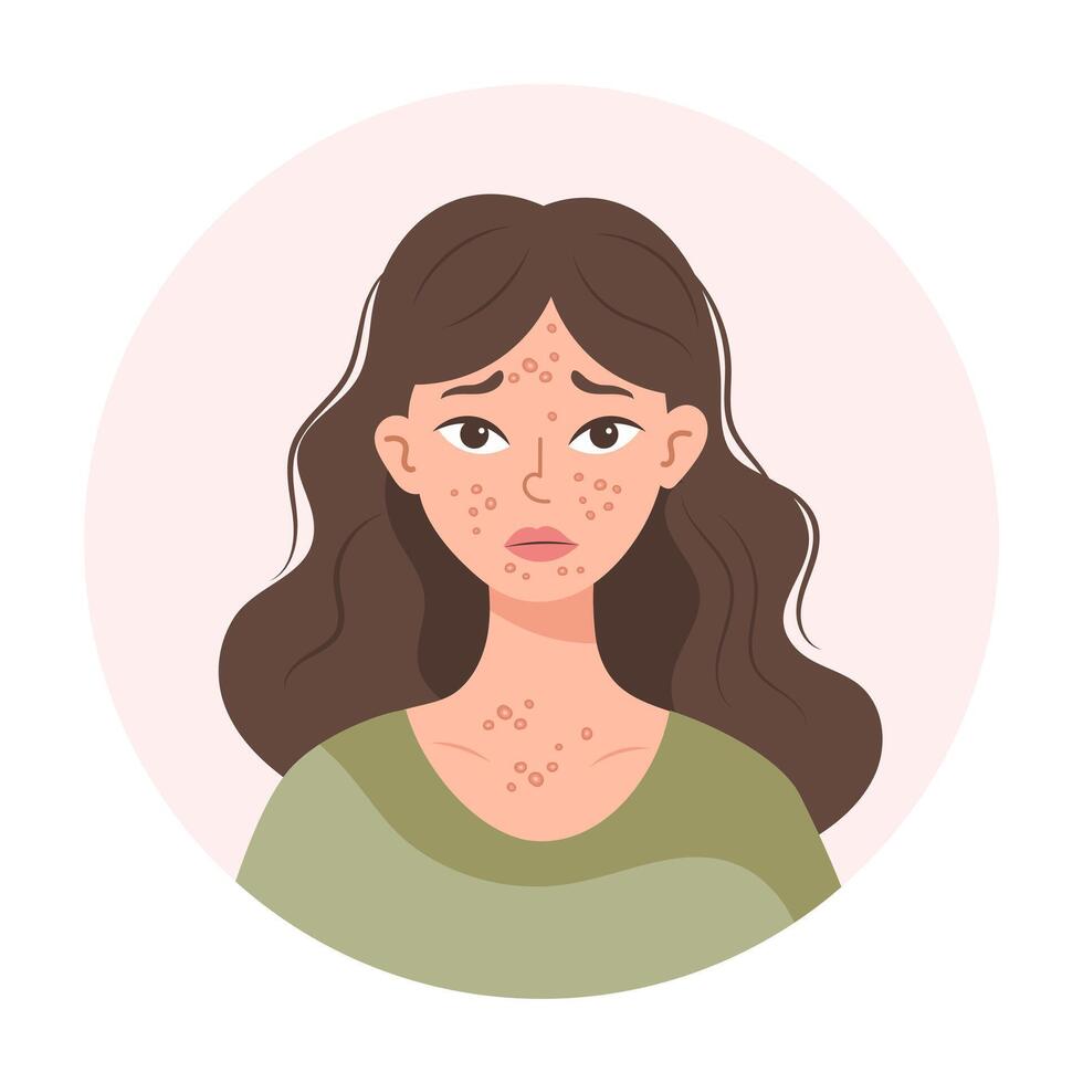 Acne. Unhappy teenage girl with acne and pimples on her face. Irritated facial skin. Illustration, vector