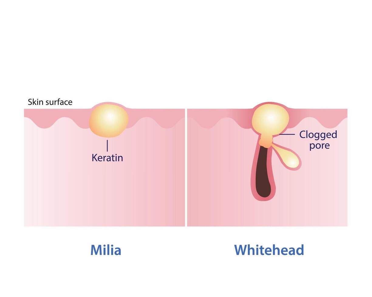 Comparison of Milia and Whitehead vector illustration isolated on white background. Milia, small white bump, trapped keratin. Whitehead, closed comedone, clogged pore. Skin care and beauty concept.