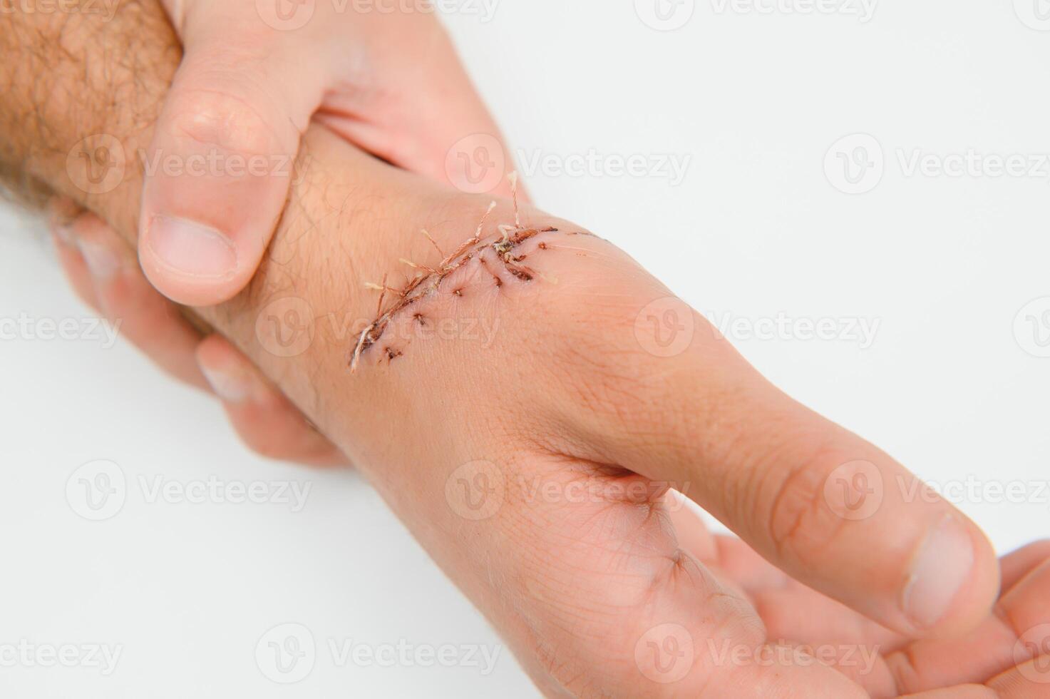 Suture wound on hand from dermatology procedure photo