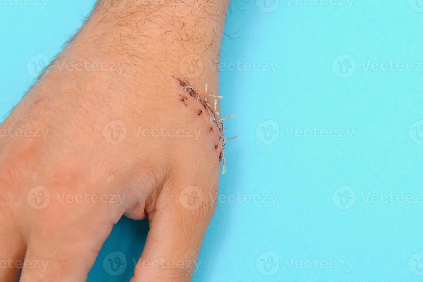 Close-up of a hand wound with stitches photo