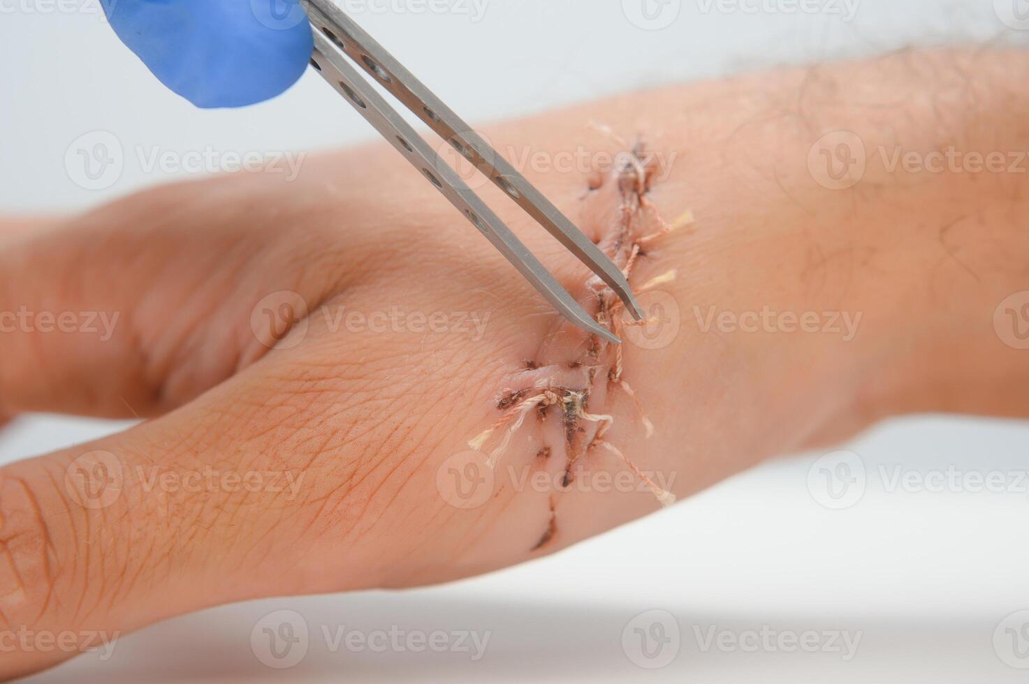 Close-up of a hand wound with stitches photo