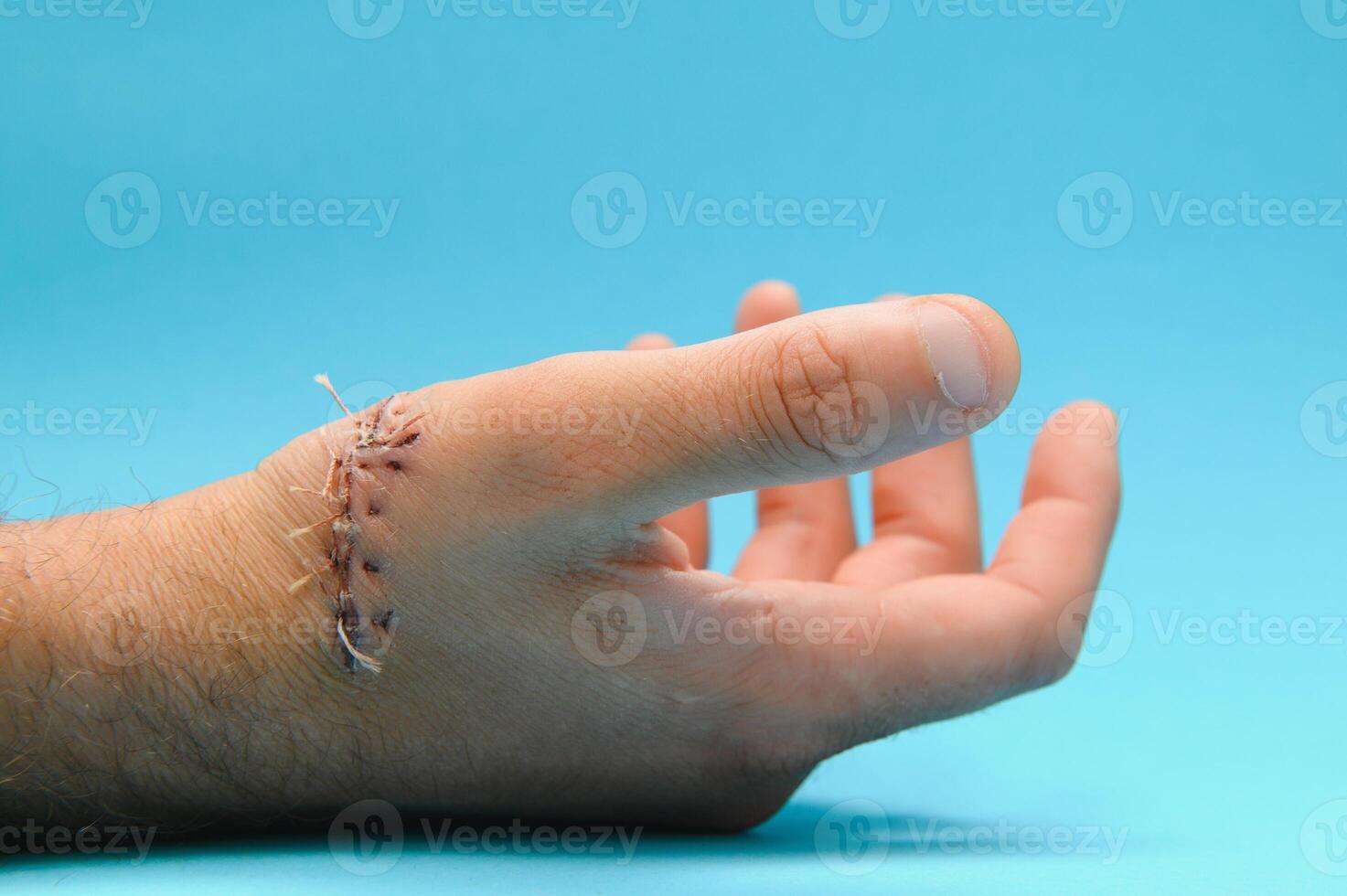 Close-up of a hand wound with stitches photo