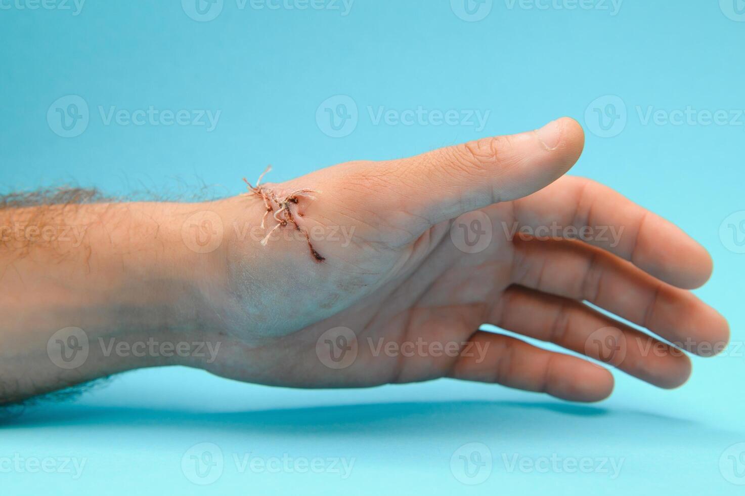 Close-up of a hand wound with stitches photo