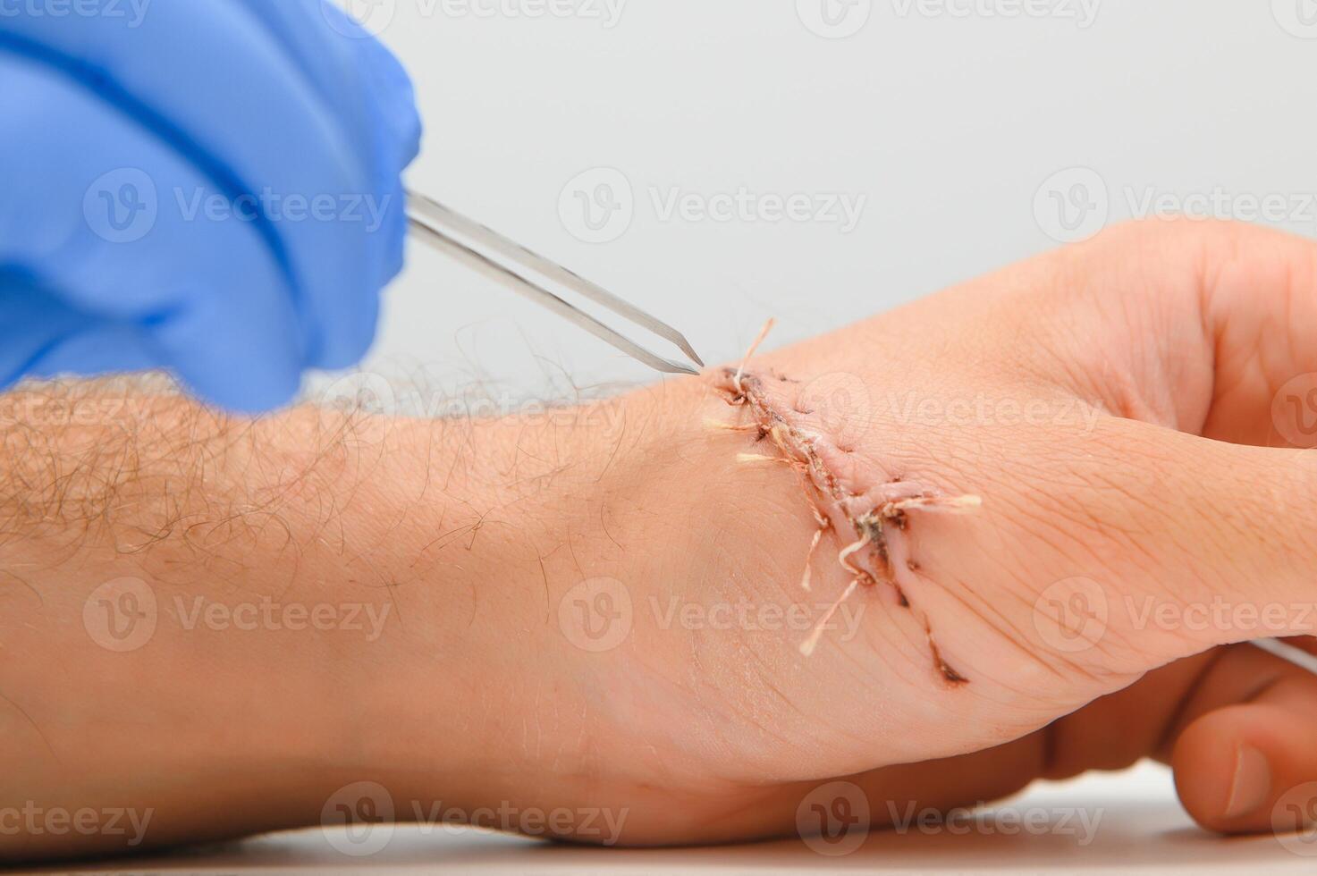 wound hand, suturing the wound. The type of cut after surgery. photo