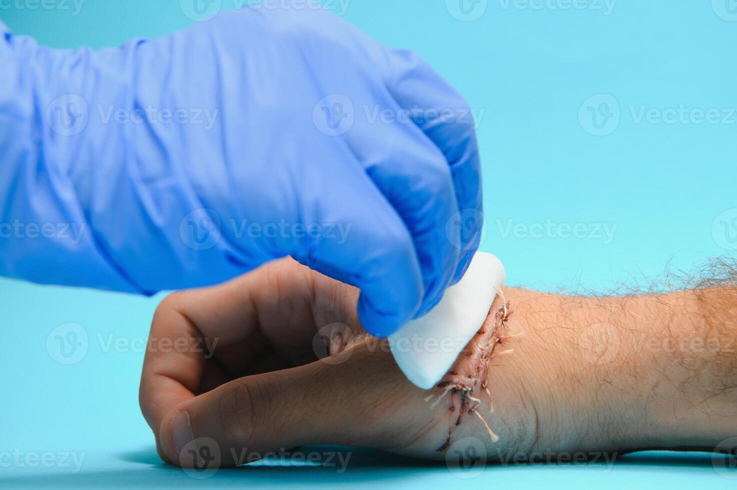 Suture wound on hand from dermatology procedure photo