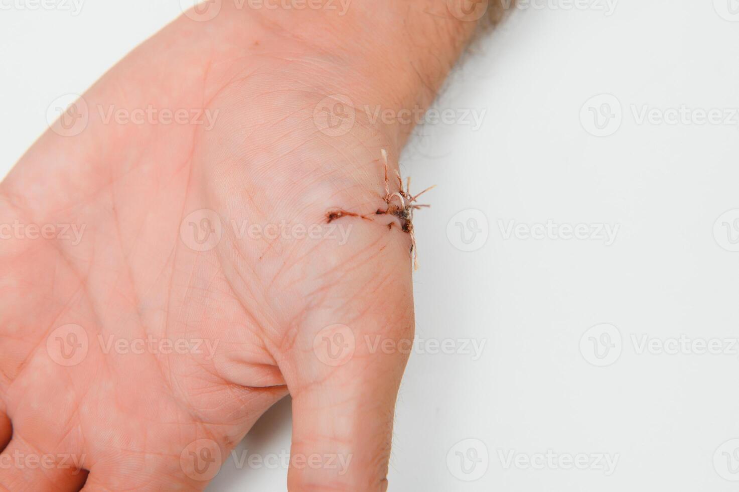 Close-up of a hand wound with stitches photo