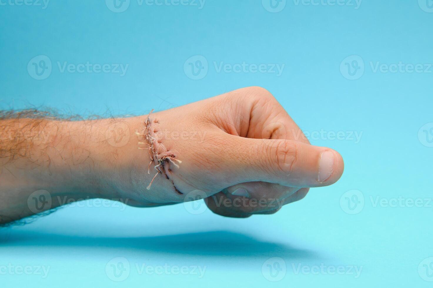 Close-up of a hand wound with stitches photo