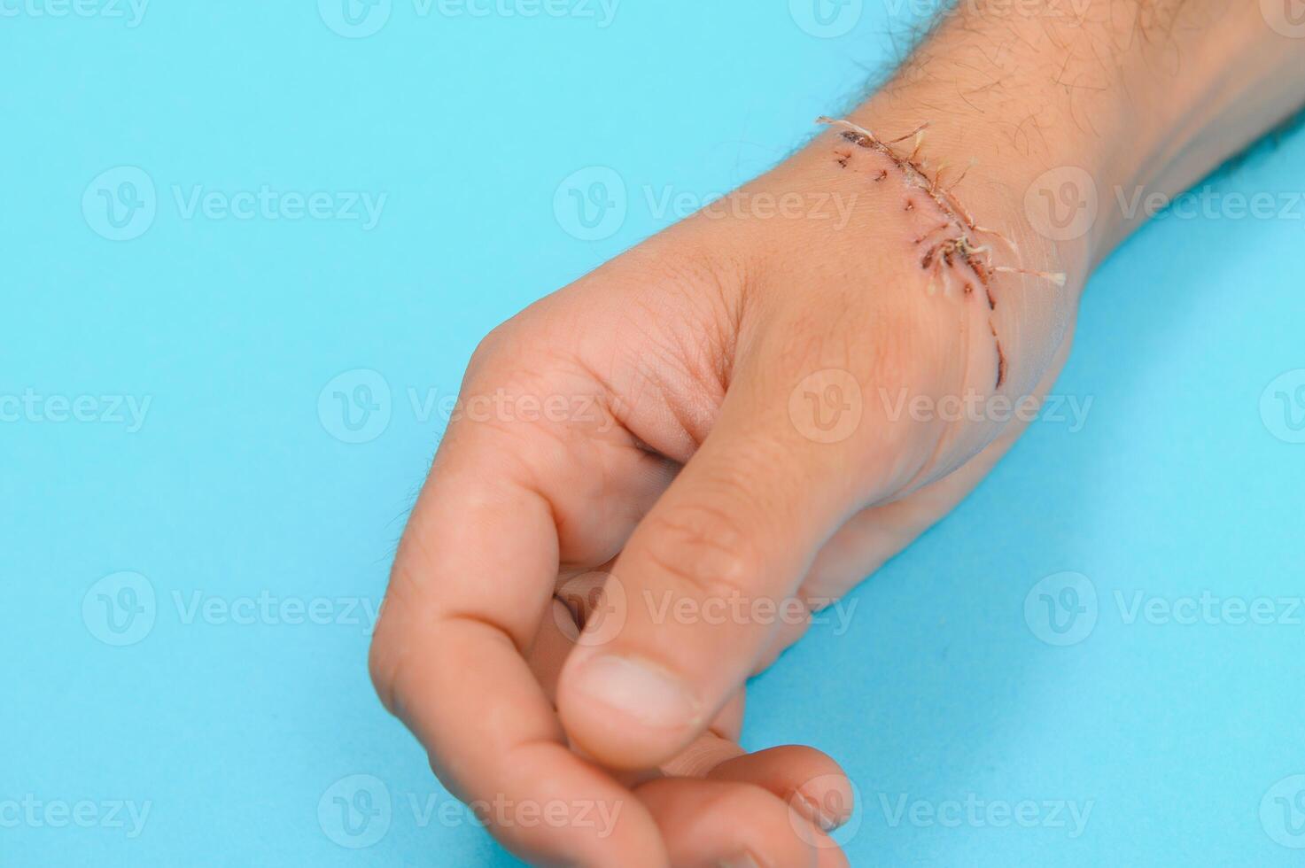 herida mano, sutura el herida. el tipo de cortar después cirugía. foto