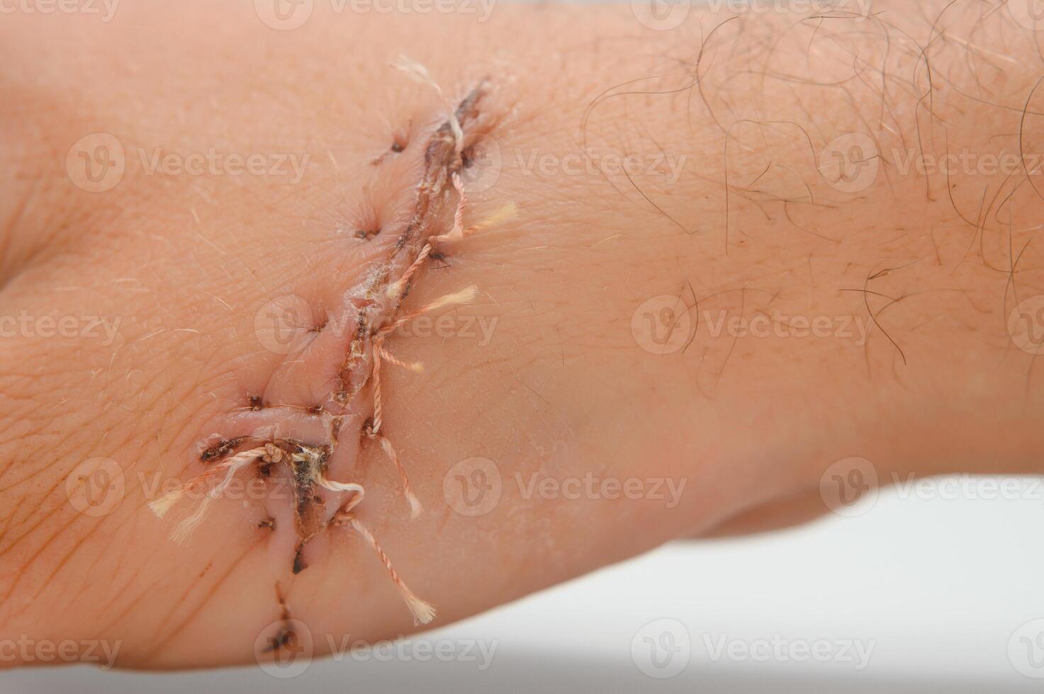 Close-up of a hand wound with stitches photo