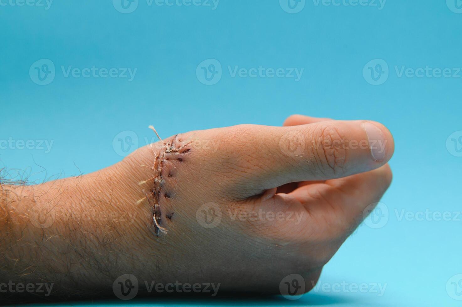 wound hand, suturing the wound. The type of cut after surgery. photo