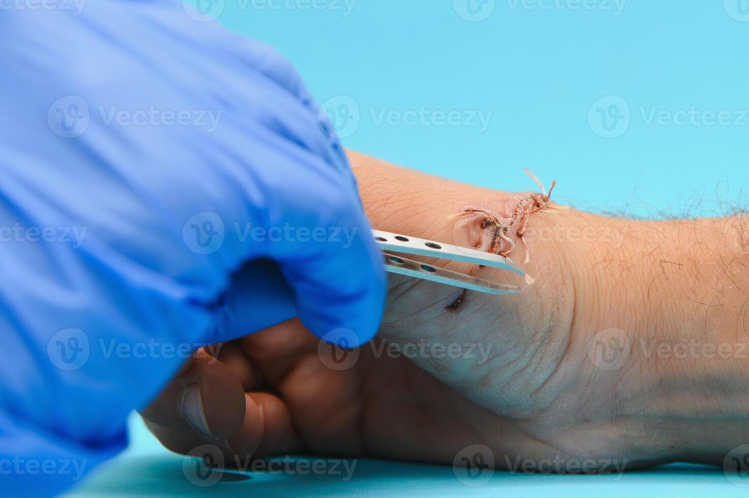 médico examinando nervio conducción en palma de mano después de mano túnel síndrome foto
