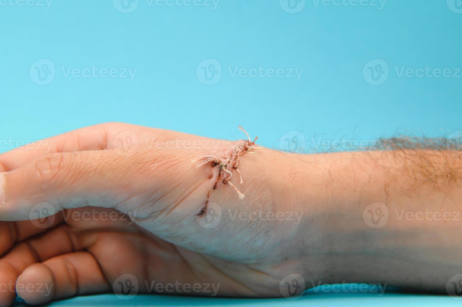 Suture wound on hand from dermatology procedure photo