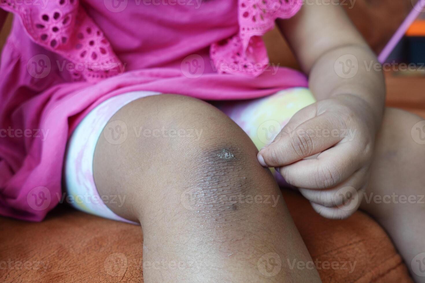 stain bruise wound on child knee. photo