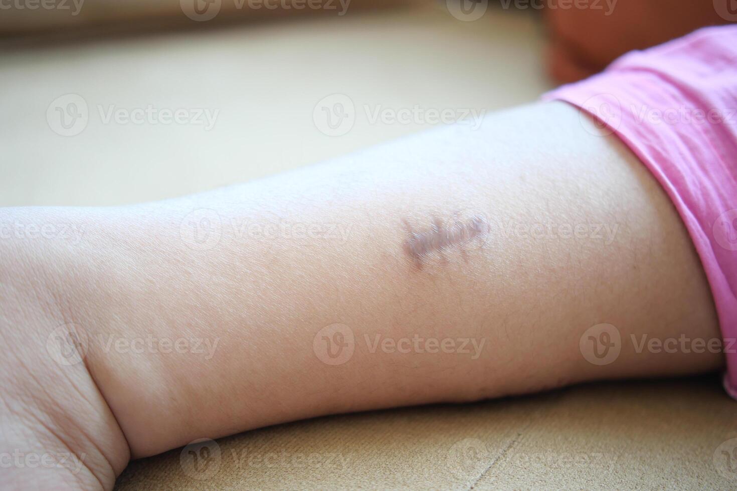 Stitched wound mark on a child foot. photo