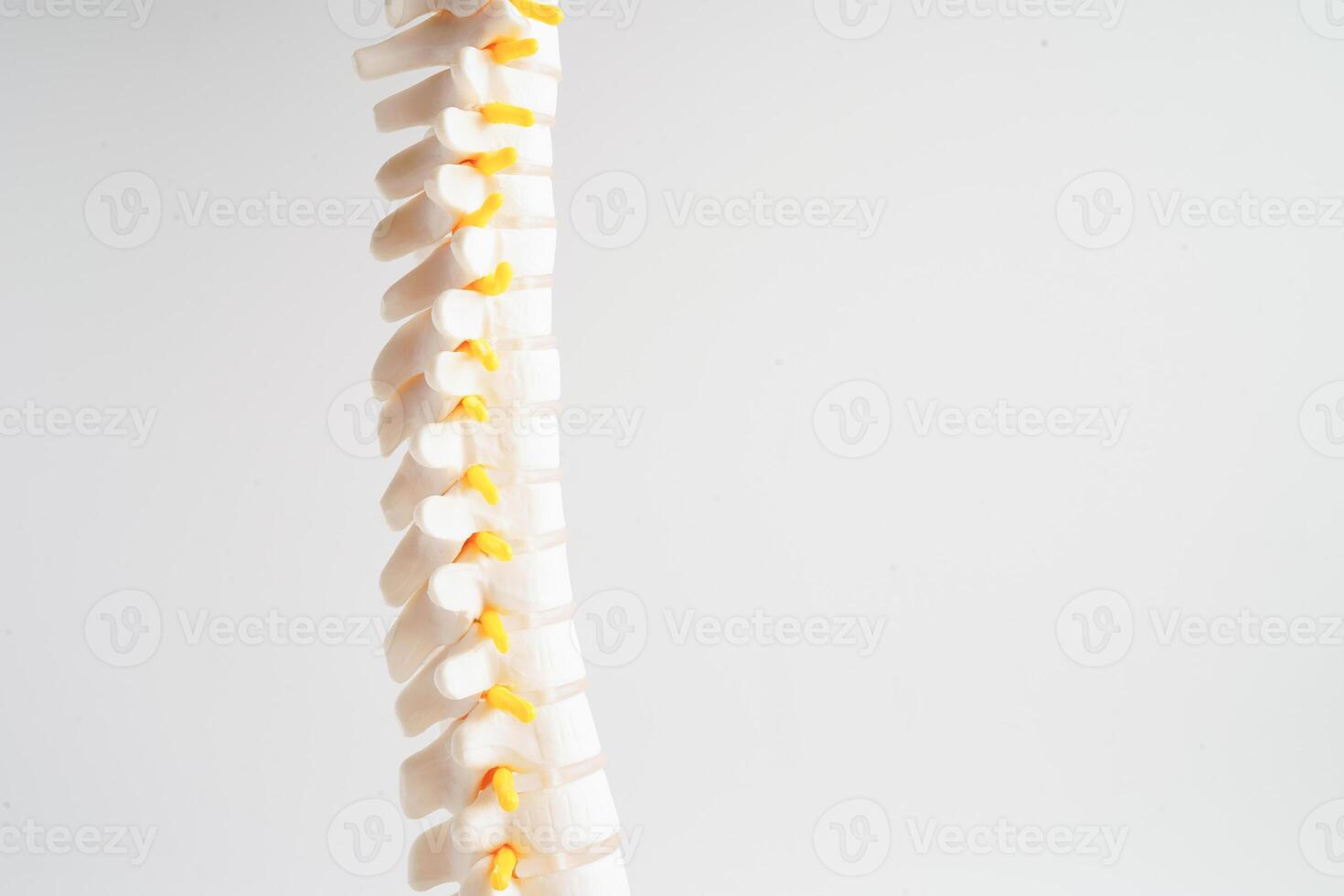 Spinal nerve and bone, Lumbar spine displaced herniated disc fragment, Model for treatment medical in the orthopedic department. photo